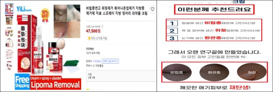 쥐젖 원인과 쥐젖 제거 크림 효능 4